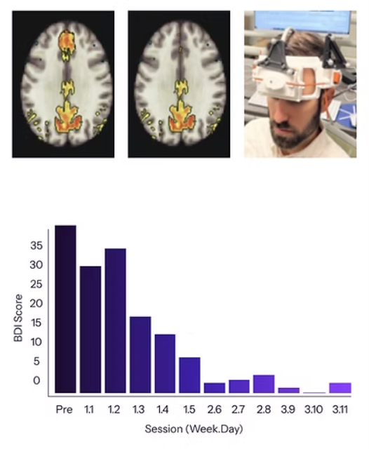 Severe Depression Severe Depression