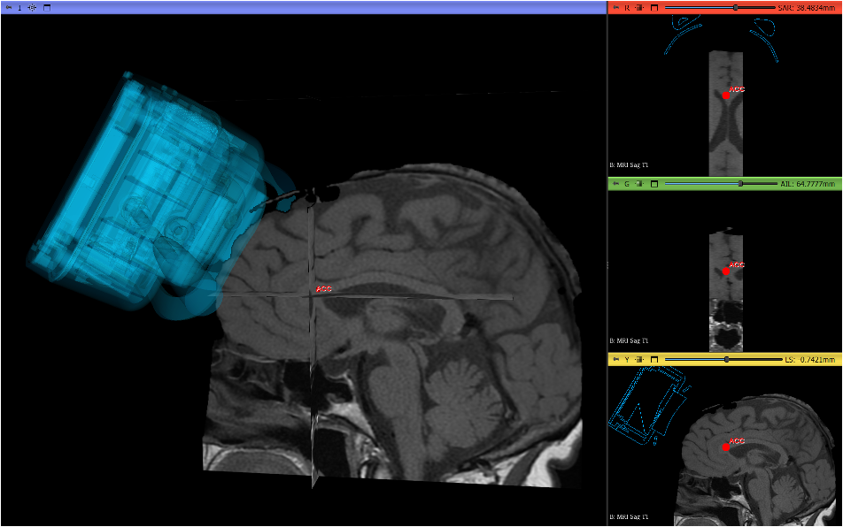 Inside Open-LIFU: How We Open-Sourced a Focused-Ultrasound Research Platform